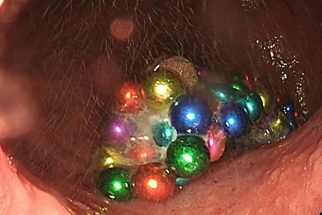 В Подмосковье полуторагодовалый ребёнок проглотил 130 магнитов и литиевую батарейку. Обложка © Минздрав Московской области