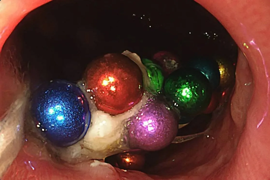 В Подмосковье полуторагодовалый ребёнок проглотил 130 магнитов и литиевую батарейку. Обложка © Минздрав Московской области