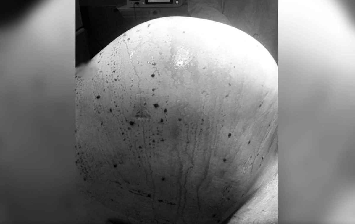 Россиянке удалили опухоль весом в 16 кг. Фото © Минздрав Московской области