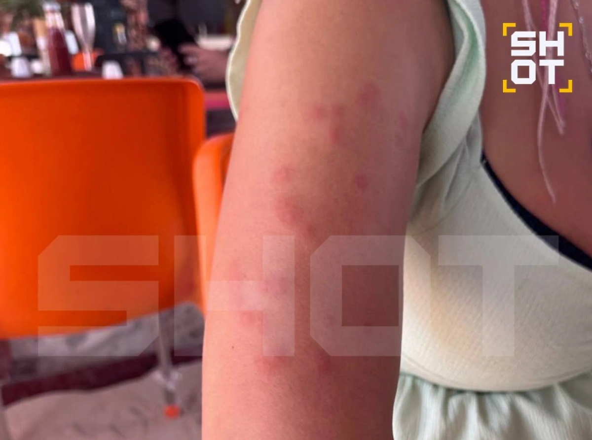 Сыпь у российских туристов, отдыхающих в Танзании. Фото © Telegram / SHOT