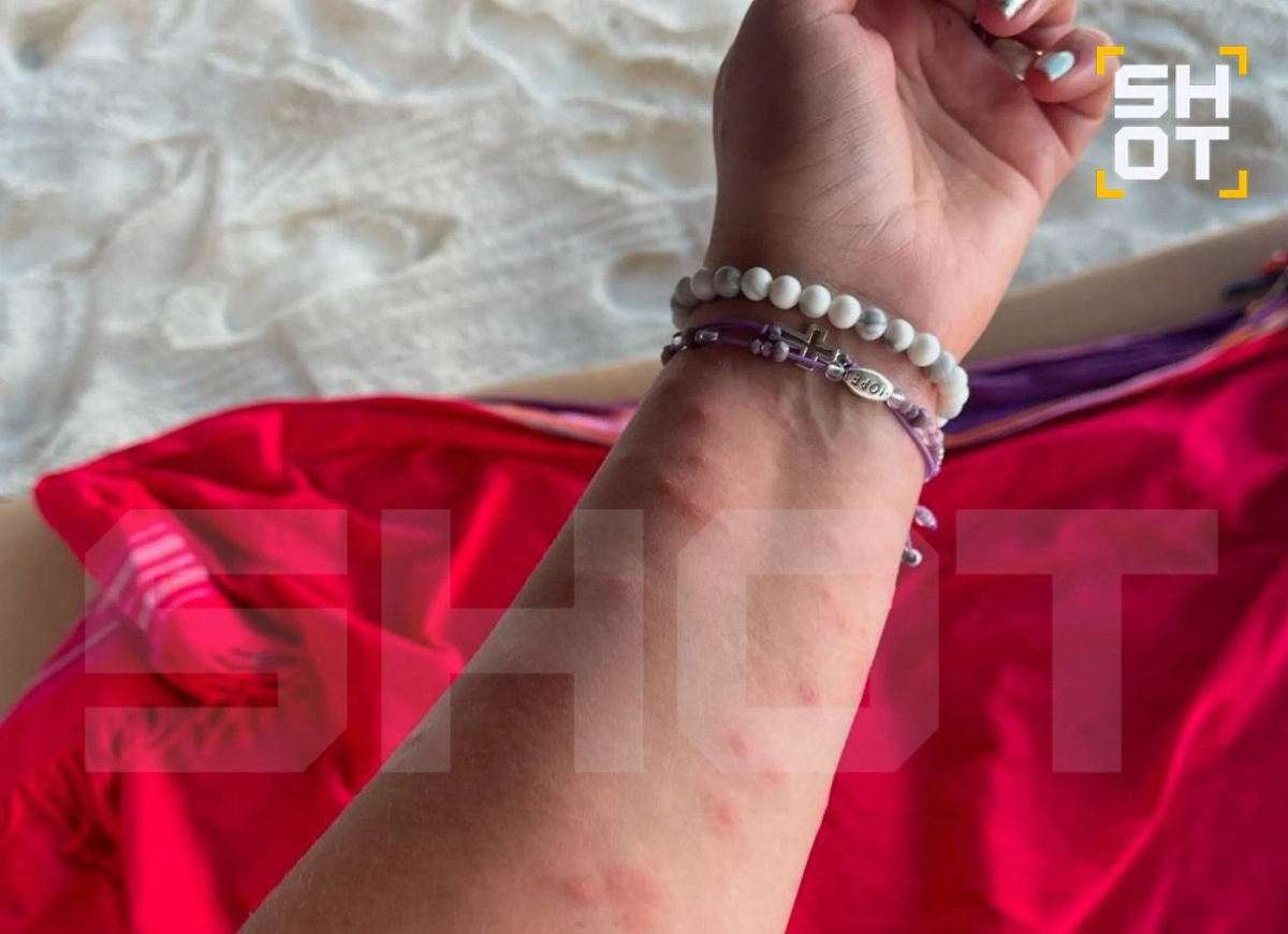 Сыпь у российских туристов, отдыхающих в Танзании. Фото © Telegram / SHOT