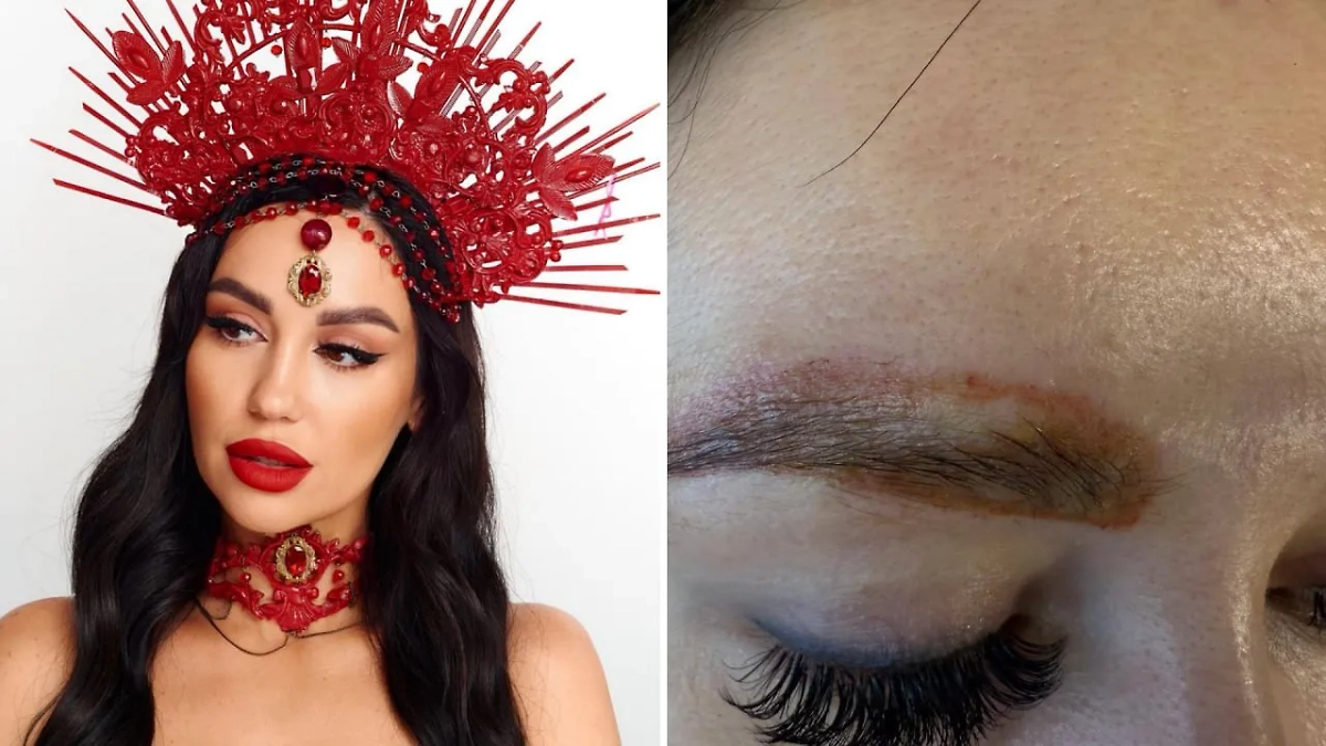 Модели выжгли брови во время сеанса по удалению татуажа в Уфе. Видео © Telegram / SHOT ПРОВЕРКА