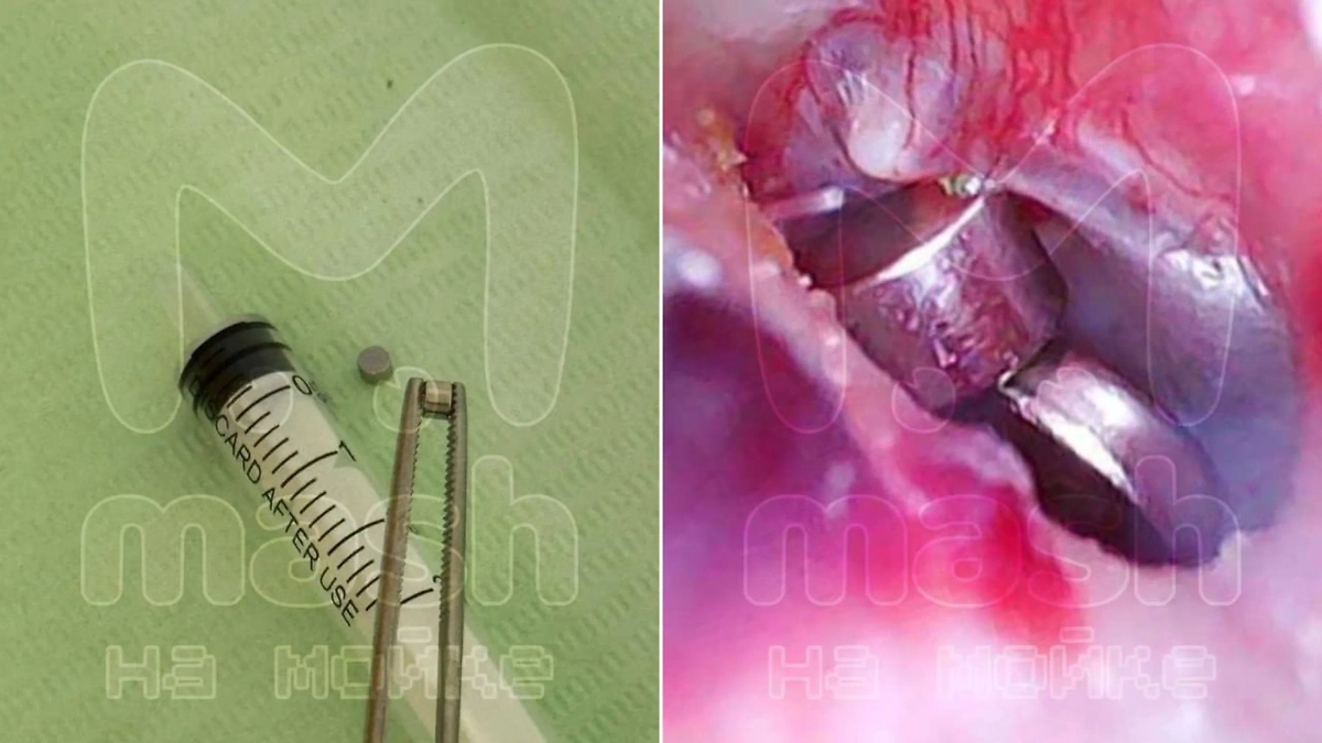Сразу два микронаушника застряли у питерского студента в ухе прямо во время экзамена. Фото © Telegram / Mash на Мойке