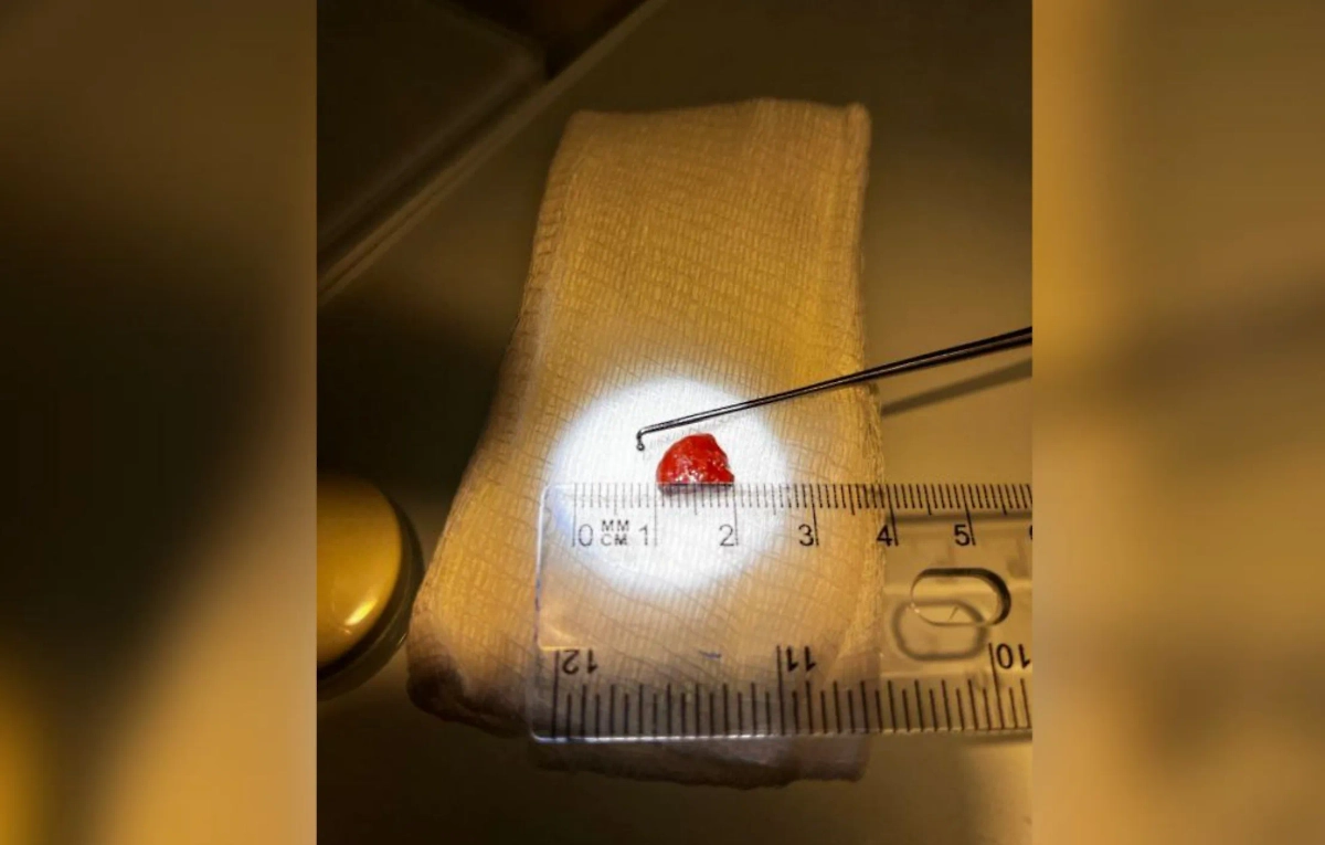 Девочка засунула камень в нос, его пришлось доставать врачам. Фото © Life.ru/Пресс-служба Клинико-диагностического центра «Ромашка»