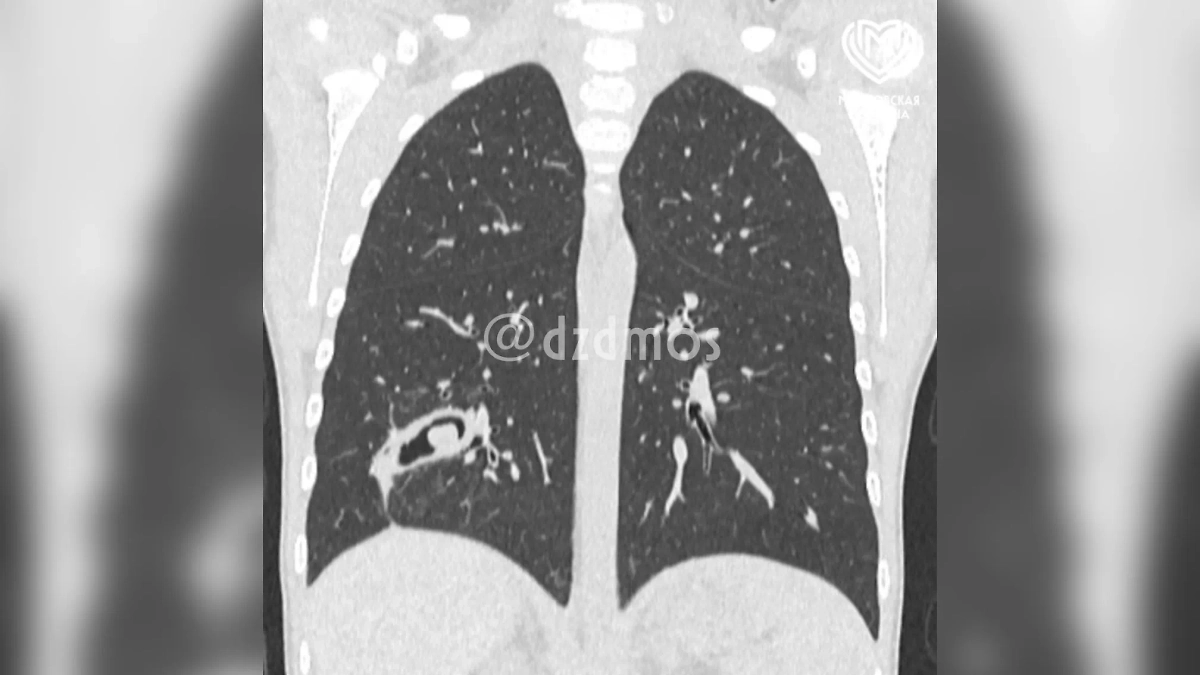 В лёгкое первоклассницы попала шелуха семечки. Фото © Telegram/ Московская медицина