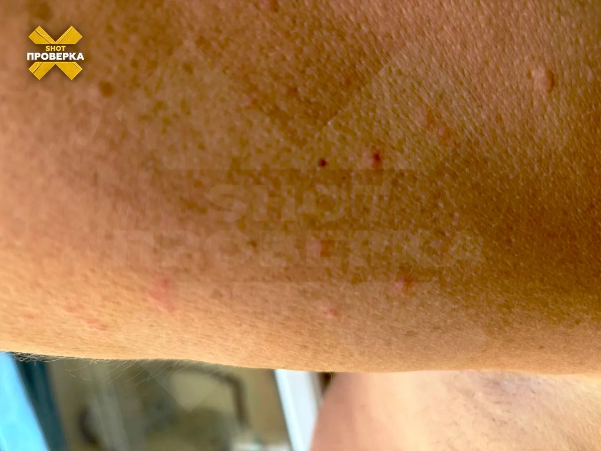 Искусанная рука туриста. Фото © Telegram / SHOT ПРОВЕРКА