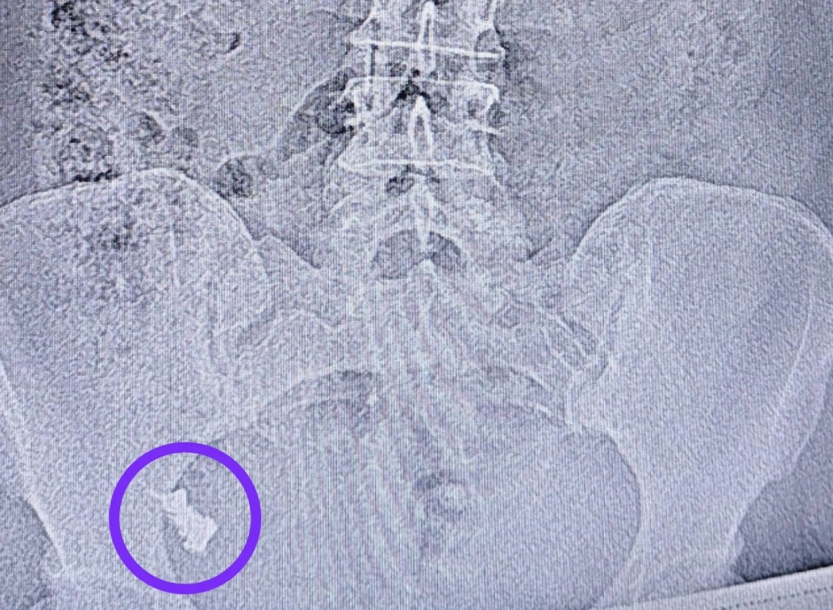 В Казани женщина проглотила зубной протез. Фото © РКБ Татарстана