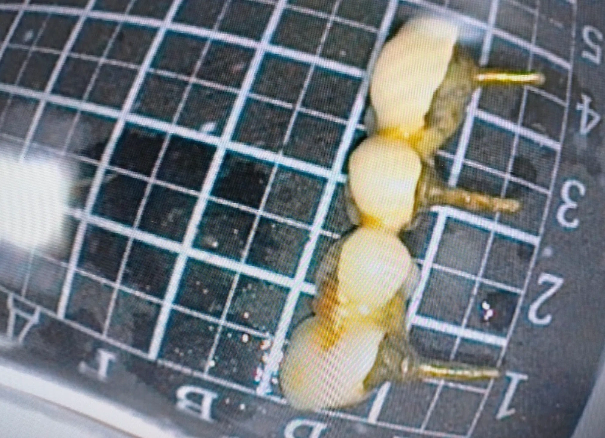 Проглоченный россиянкой зубной протез. Фото © РКБ Татарстана