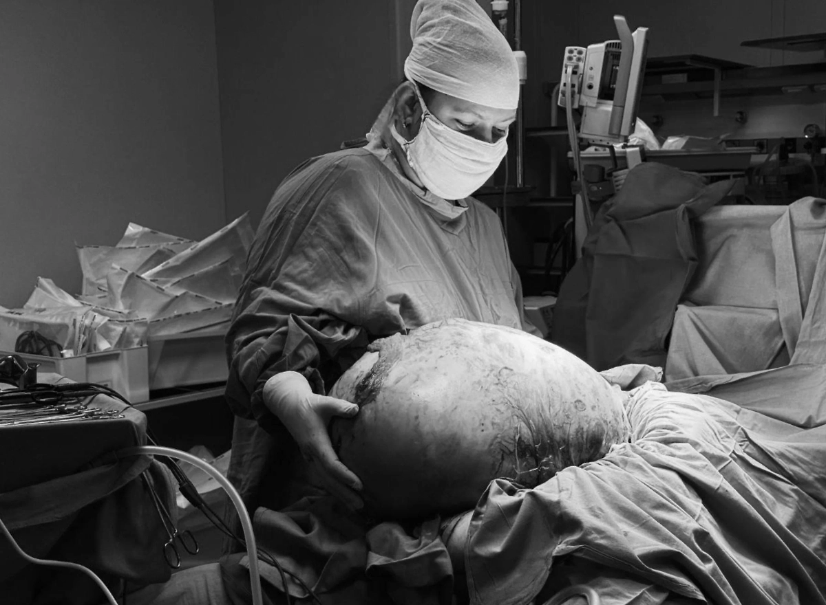 20-килограммовая опухоль, которую удалили пациентке. Фото © Министерство здравоохранения Московской области