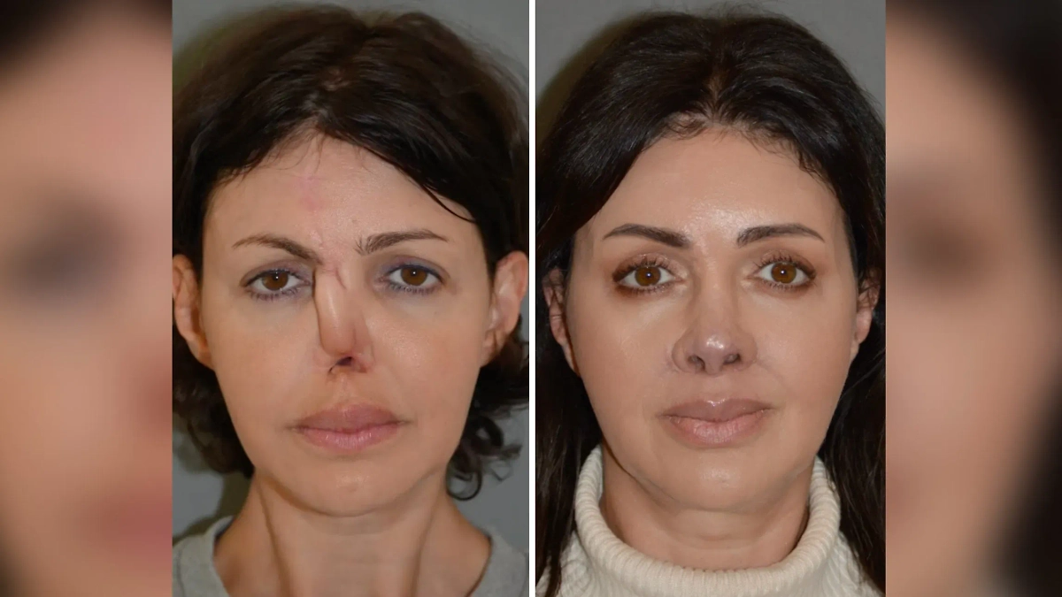 Алиса Казьмина до и после операций. Обложка © Telegram / Агапов Денис Генрихович | Пластический хирург