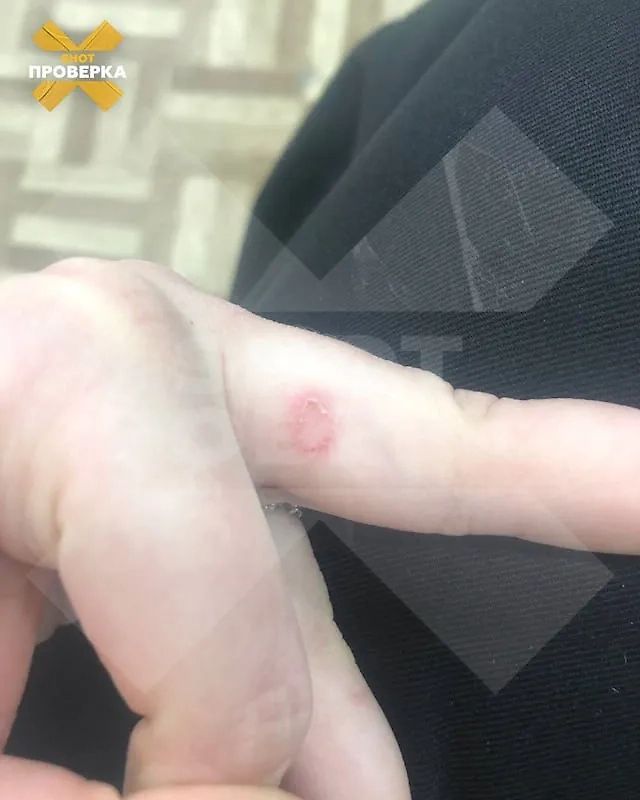 Шрамы вместо тату. Фото © SHOT ПРОВЕРКА