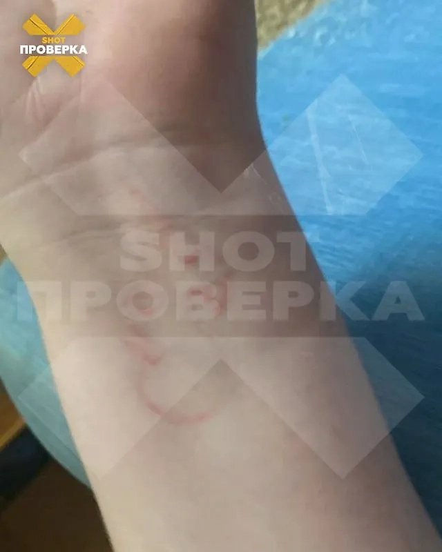 Шрамы вместо тату. Фото © SHOT ПРОВЕРКА