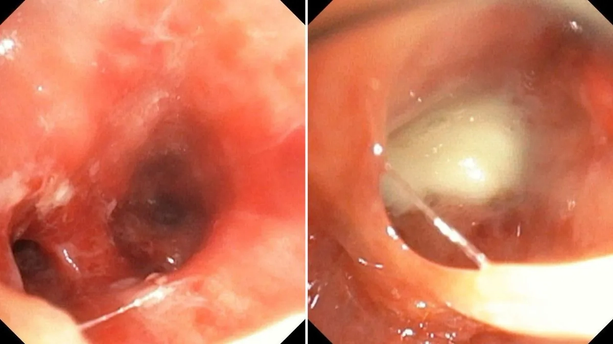 В больнице Красногорска спасли женщину с капустой в бронхах. Фото © Telegram / Министерство здравоохранения Московской области