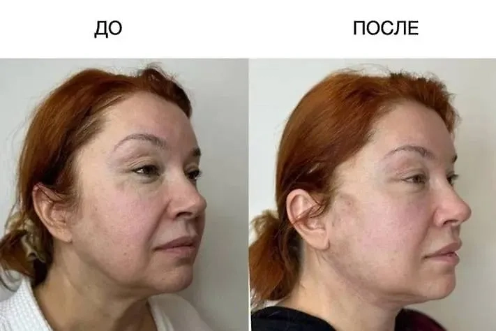 Вера Сотникова до и после операции. Фото © Клиника «Век Адалин»
