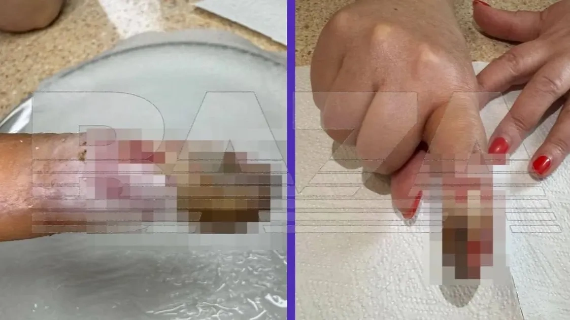 Жительница Подмосковья потеряла фалангу пальца после операции в частной клинике. Фото © Telegram / Baza