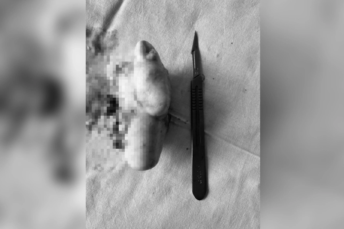 Новообразование, которое удалили врачи. Фото © Предоставлено Life.ru пресс-службой Министерства здравоохранения РФ