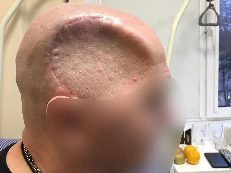 У военнослужащего осталась вмятина на черепе: отсутствует часть кости. Фото © RT