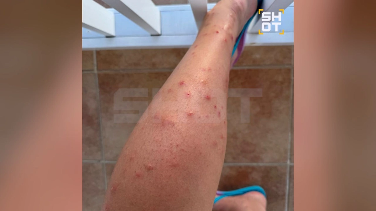 SHOT: Москиты проснулись на Кубе после урагана, туристов мучает зуд и бессонница