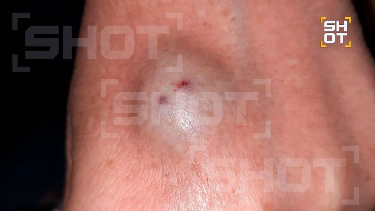 SHOT: Россиянка получила сильное воспаление от укуса верблюжьего паука в Египте. Фото © SHOT