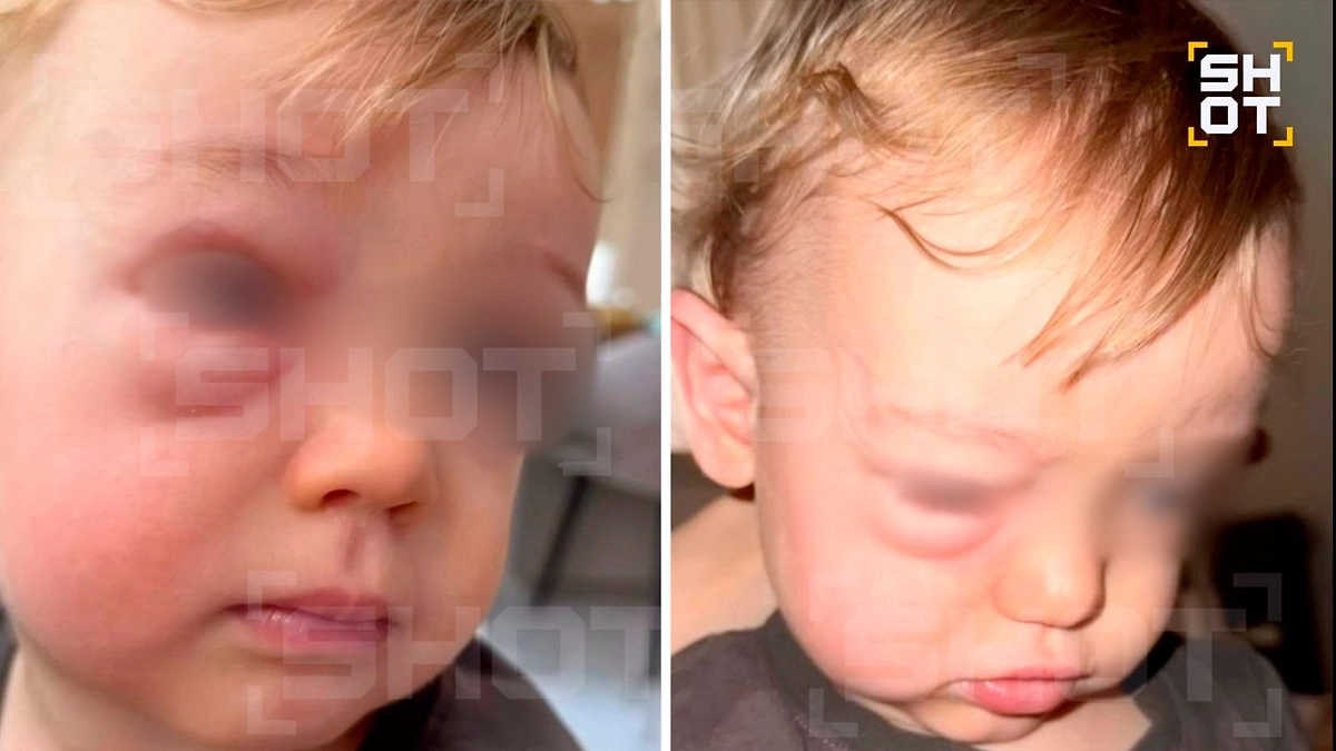 В Москве годовалый ребёнок чуть не ослеп из-за домашнего промывания носа В Москве годовалый ребёнок чуть не ослеп из-за домашнего промывания носа