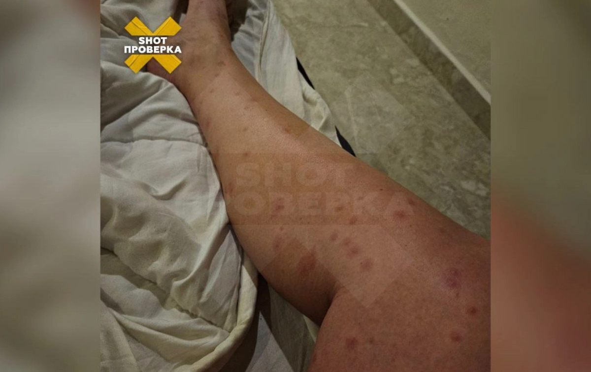 Укусы песчаных мух. Фото © Telegram / SHOT ПРОВЕРКА