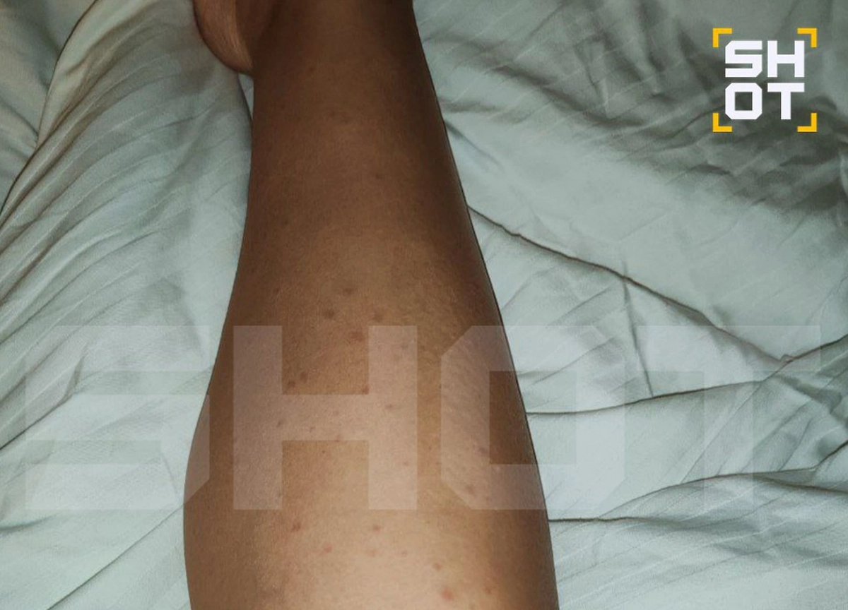 Укусы клопов в отеле в Египте. Фото © Telegram / SHOT