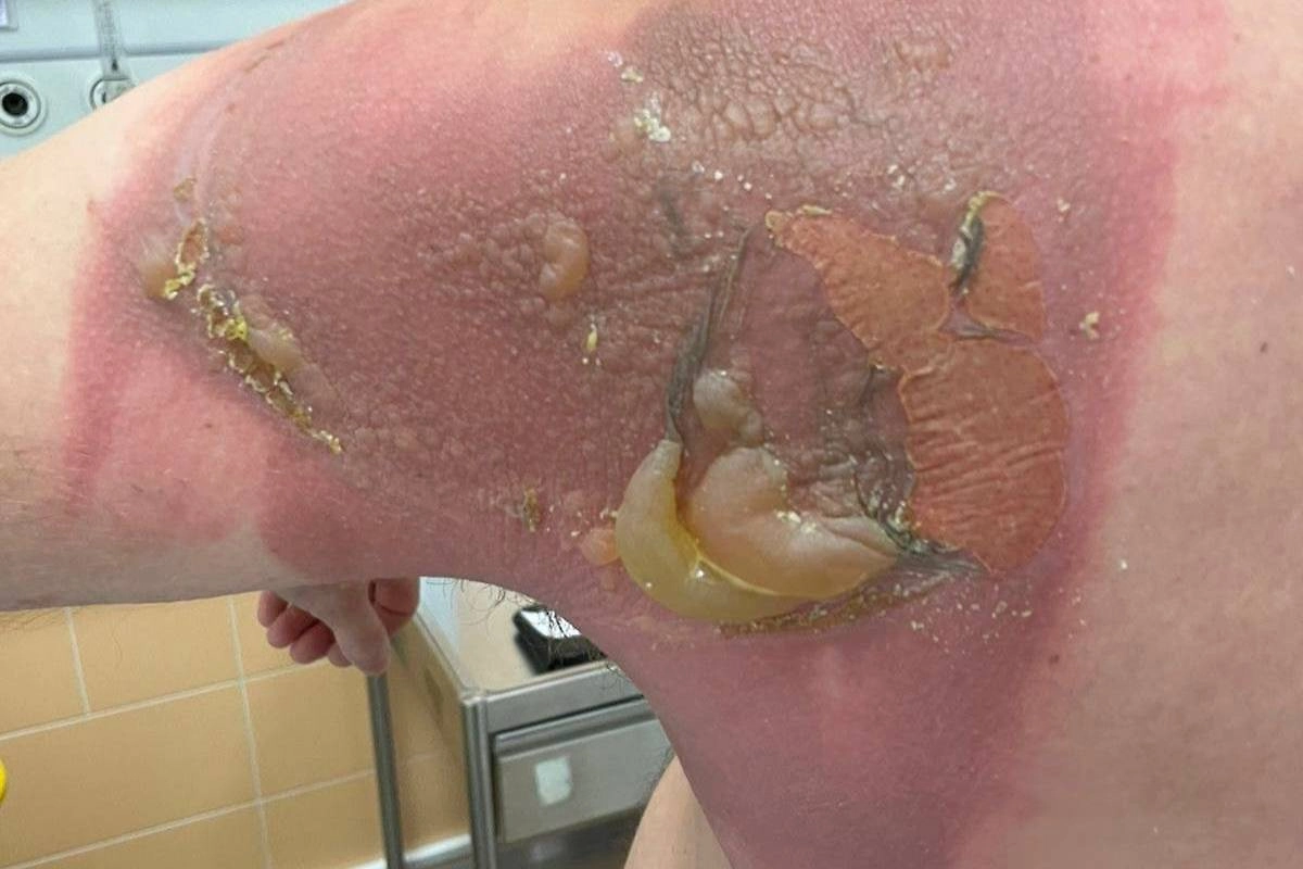 Ожог спины, вероятно, произошёл из-за капсул стирки. Фото © Telegram / Mash