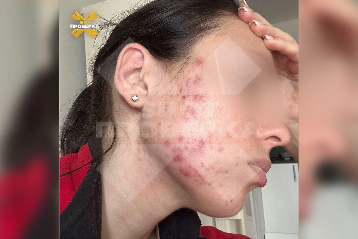 У девушки развилась тяжёлая форма акне после лицевого массажа. Фото © SHOT ПРОВЕРКА