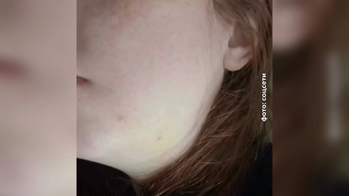 Жительница Подмосковья оказалась в реанимации после удаления зуба в частной клинике