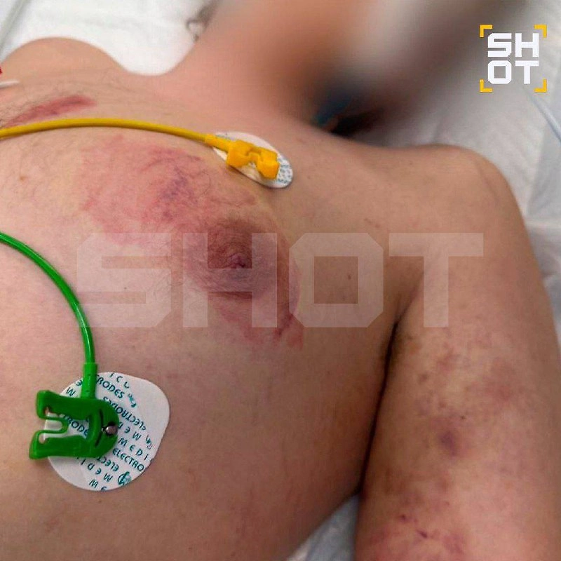 Подросток из нелегального рехаба в Подмосковье впал в кому после избиений