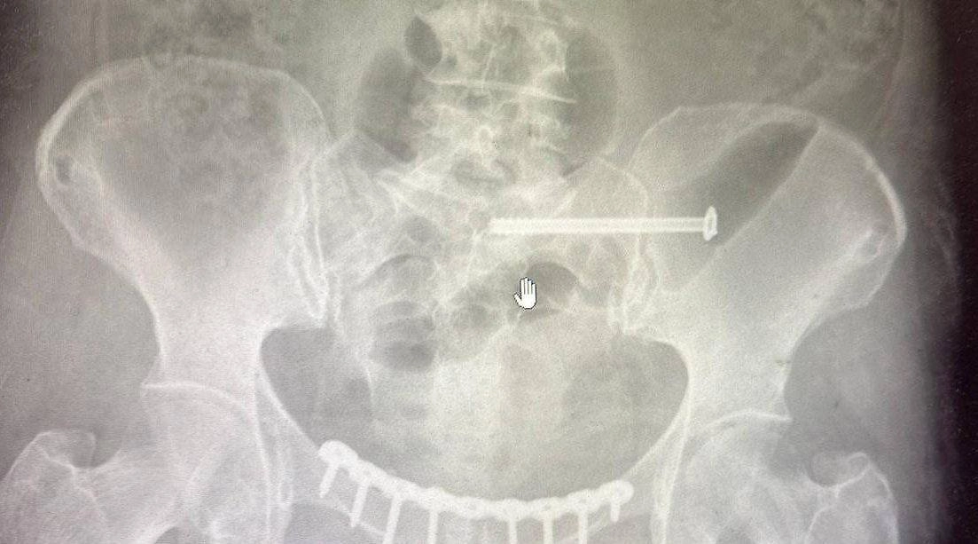 Рентгеновский снимок жительницы Подмосковья после тяжёлой травмы. Фото © Министерство здравоохранения Московской области
