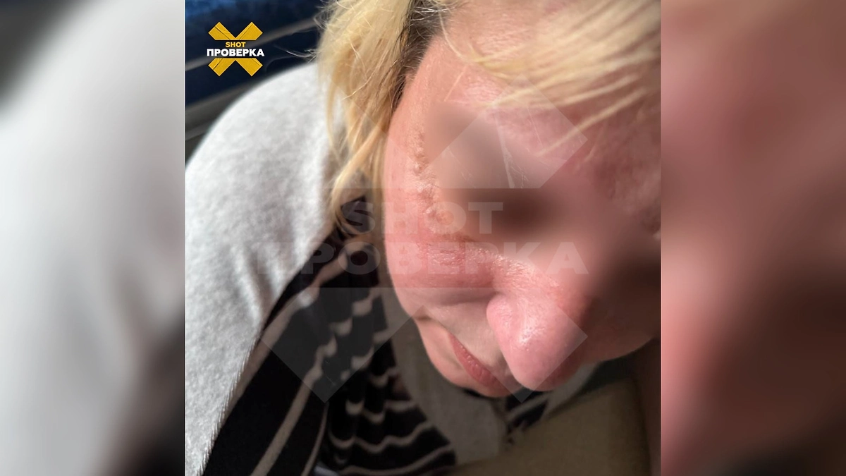 После инъекций «Дермахила» в местах введения появляются воспаления и мелкие бугорки, в некоторых случаях начинается загноение. Фото © Telegram / SHOT ПРОВЕРКА