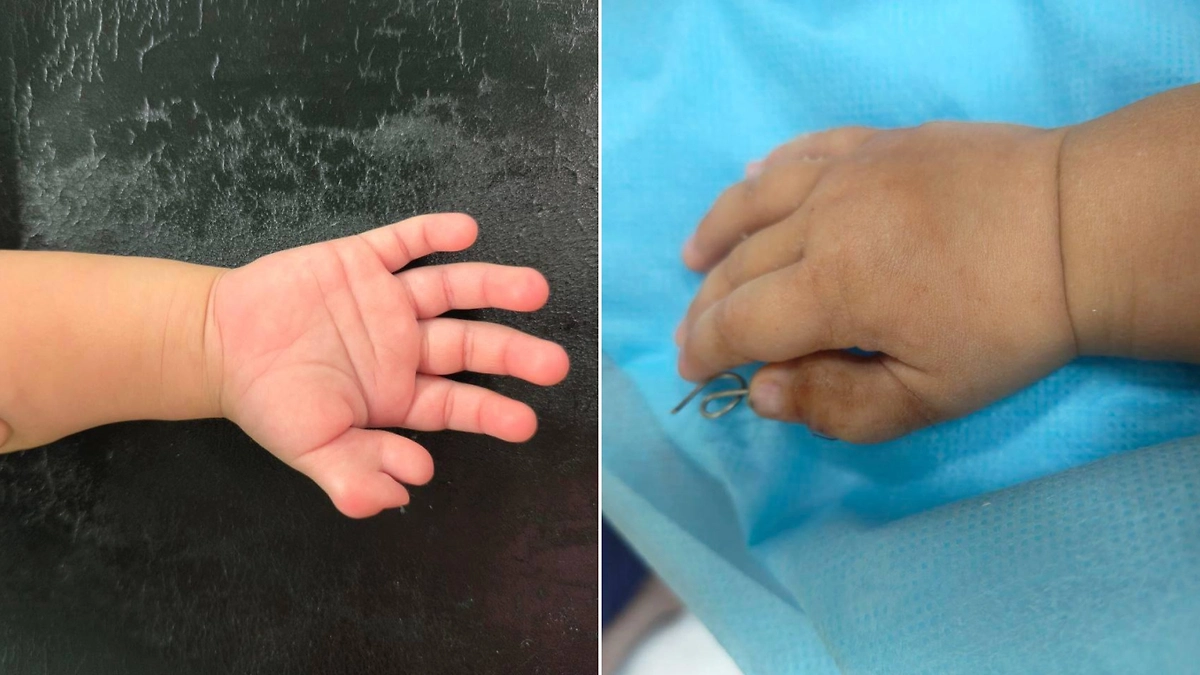 До / После операции по удалению шестого пальца на руке малыша из Подмосковья. Фото © Telegram / Разборчивым почерком