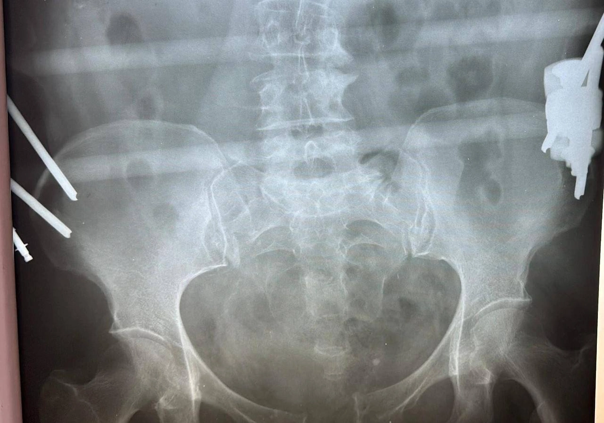 Рентгеновский снимок жительницы Подмосковья после тяжёлой травмы. Фото © Министерство здравоохранения Московской области