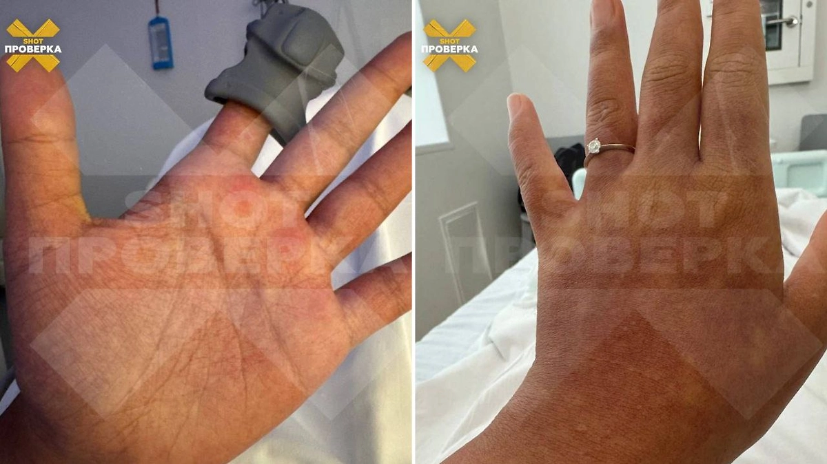Последствия заболевания лихорадкой. Фото © Telegram / SHOT ПРОВЕРКА
