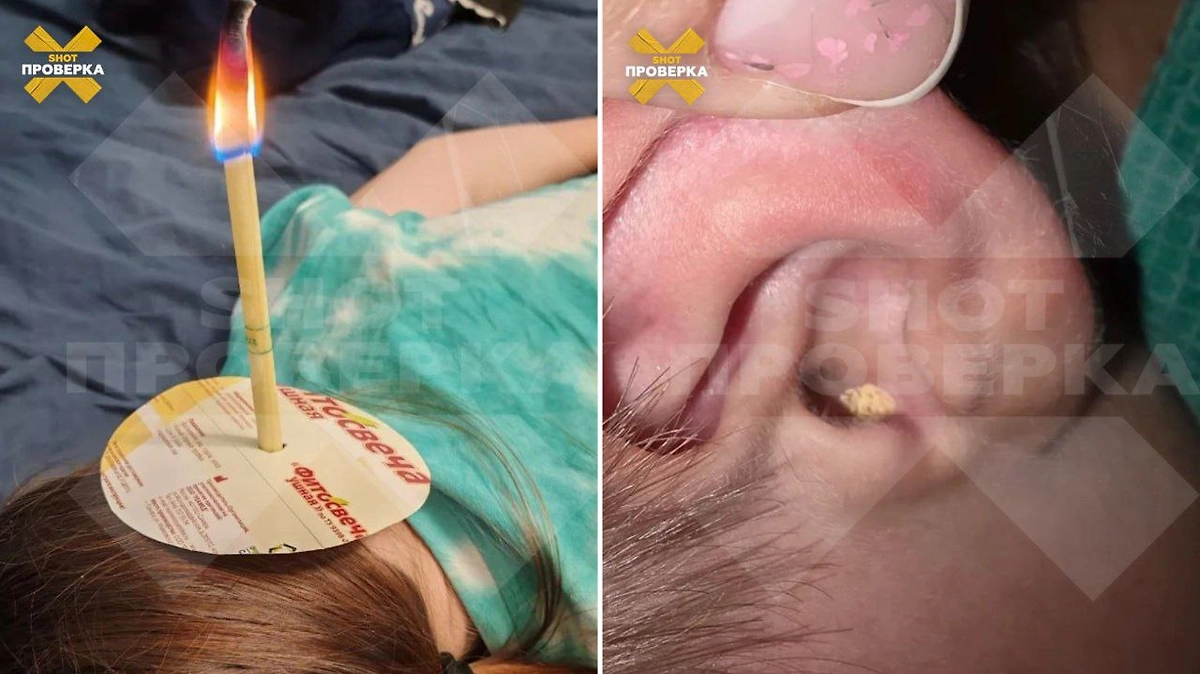 Ушные восковые свечи могут привести к трещинам в барабанной перепонке и глухоте. Фото © Telegram / SHOT ПРОВЕРКА