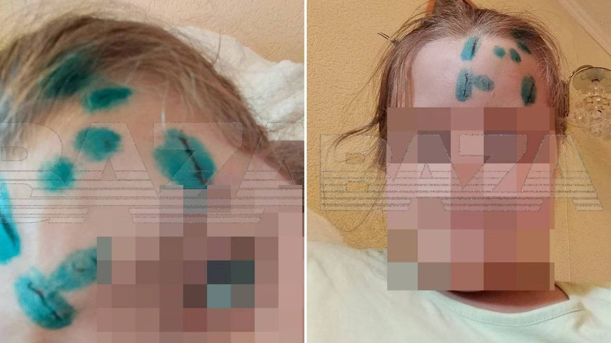 Травмы 9-детней девочки после нападаения маргинала. Фото © Telegram / Baza