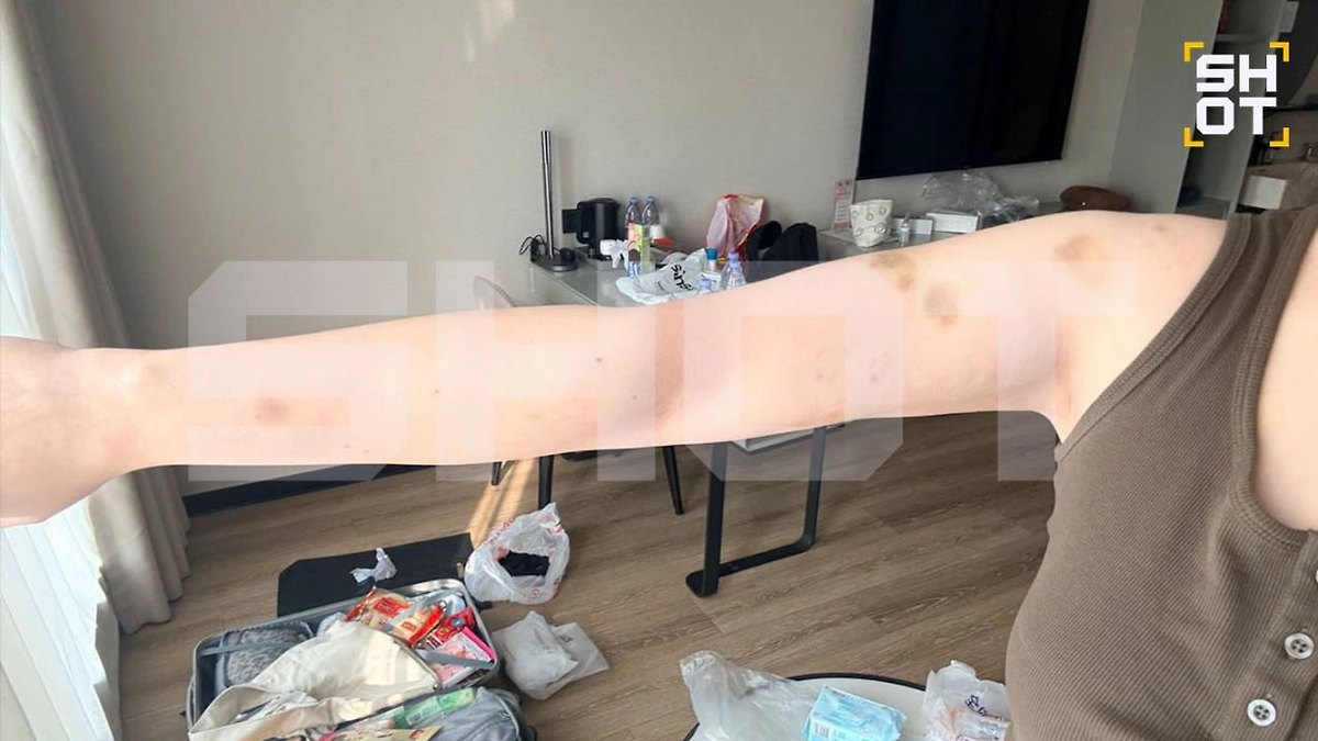 Травмы, полученные россиянкой от возлюбленного из Китая. Фото © Telegram / SHOT