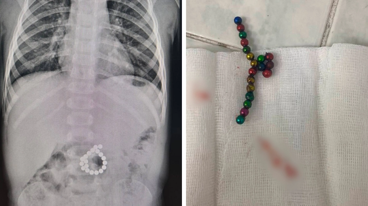 Ребёнок проглотил 19 магнитов из детского конструктора. Фото © Telegram / Роман Паськов