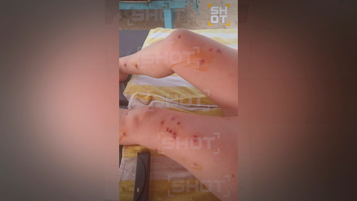 Россияне на Гоа сталкиваются с жуткими последствиями укусов тигровых комаров. Фото © SHOT