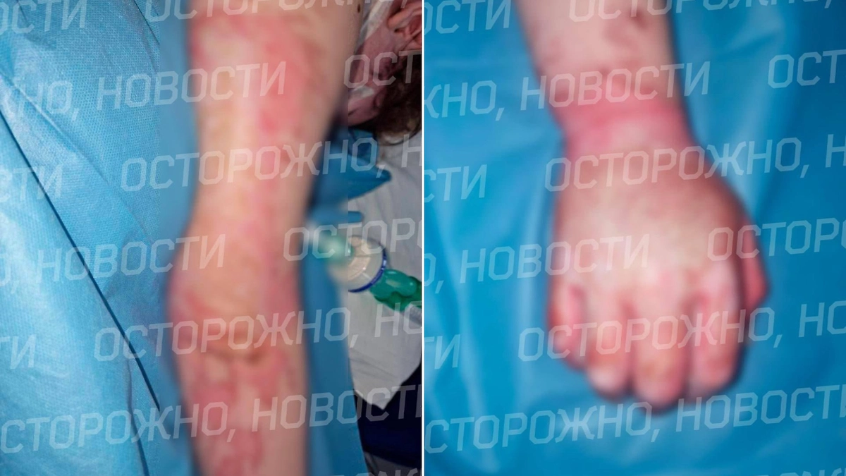 Девушку увезли в больницу с ожогами второй и третьей степени на более чем 40% тела. Фото © Telegram / Осторожно, новости