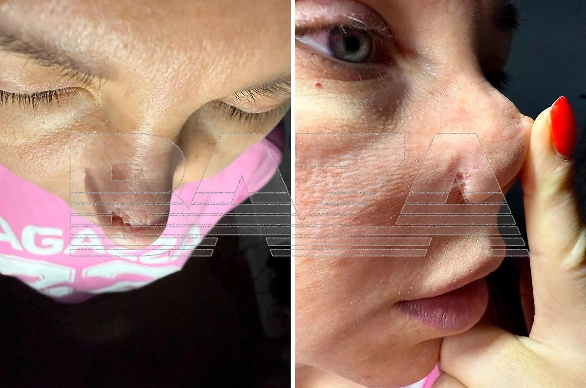 Последствия неудачной ринопластики. Фото © Baza