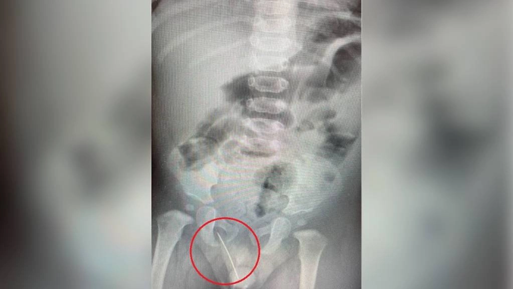 Иголка, застрявшая в теле малыша. Фото © Министерство здравоохранения по Московской области