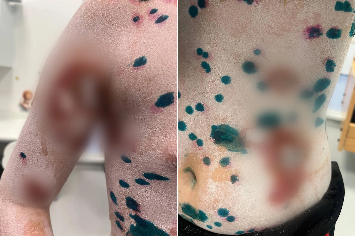 Врачи спасли девочку от синдрома Стивенса-Джонсона. Фото © Министерство здравоохранения Московской области