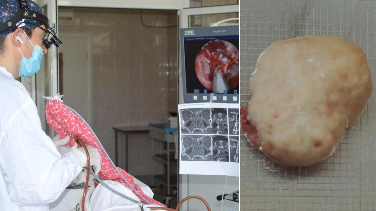 Житель Подмосковья жаловался на насморк, а врачи нашли раковую опухоль. Фото © пресс-служба Ступинской больницы