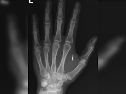 Фокусник в США заблокировал микрочип в руке и сам себя лишил доступа. Фото © Facebook (признан экстремистской организацией и запрещён на территории Российской Федерации) / Zi Teng Wang