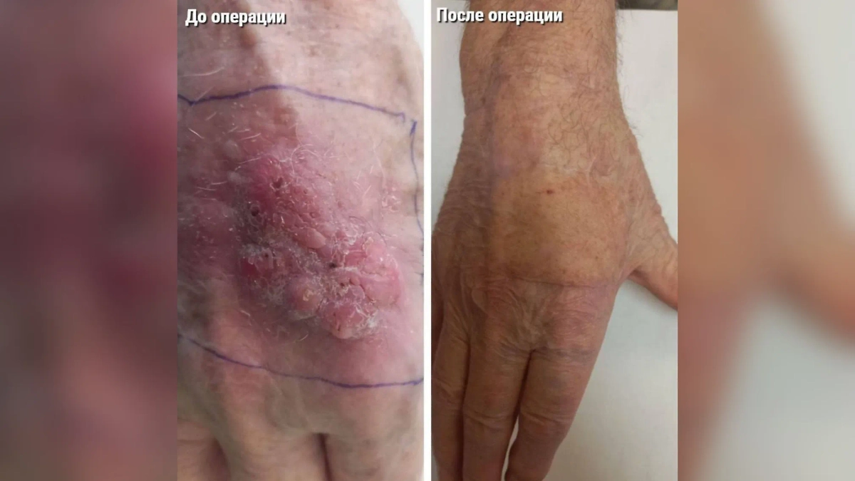 Рубец практически незаметно. Фото © Пресс-служба Министерства здравоохранения Московской области