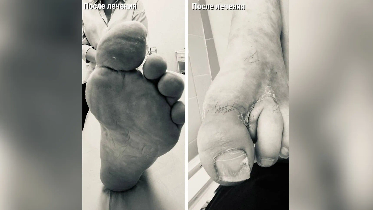Состояние ноги пациентки после лечения. Фото © mz.mosreg.ru