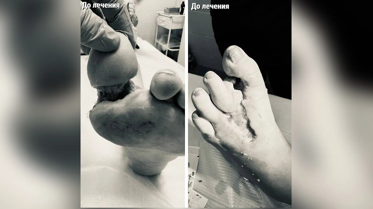 Состояние ноги пациентки до лечения. Фото © mz.mosreg.ru