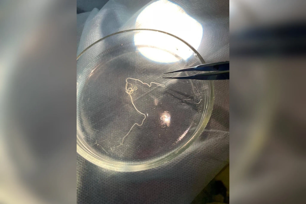 Извлечённый гельминт. Фото © Telegram / Минздрав Башкортостана